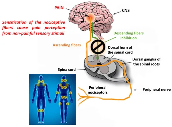 Fibromyalgia 